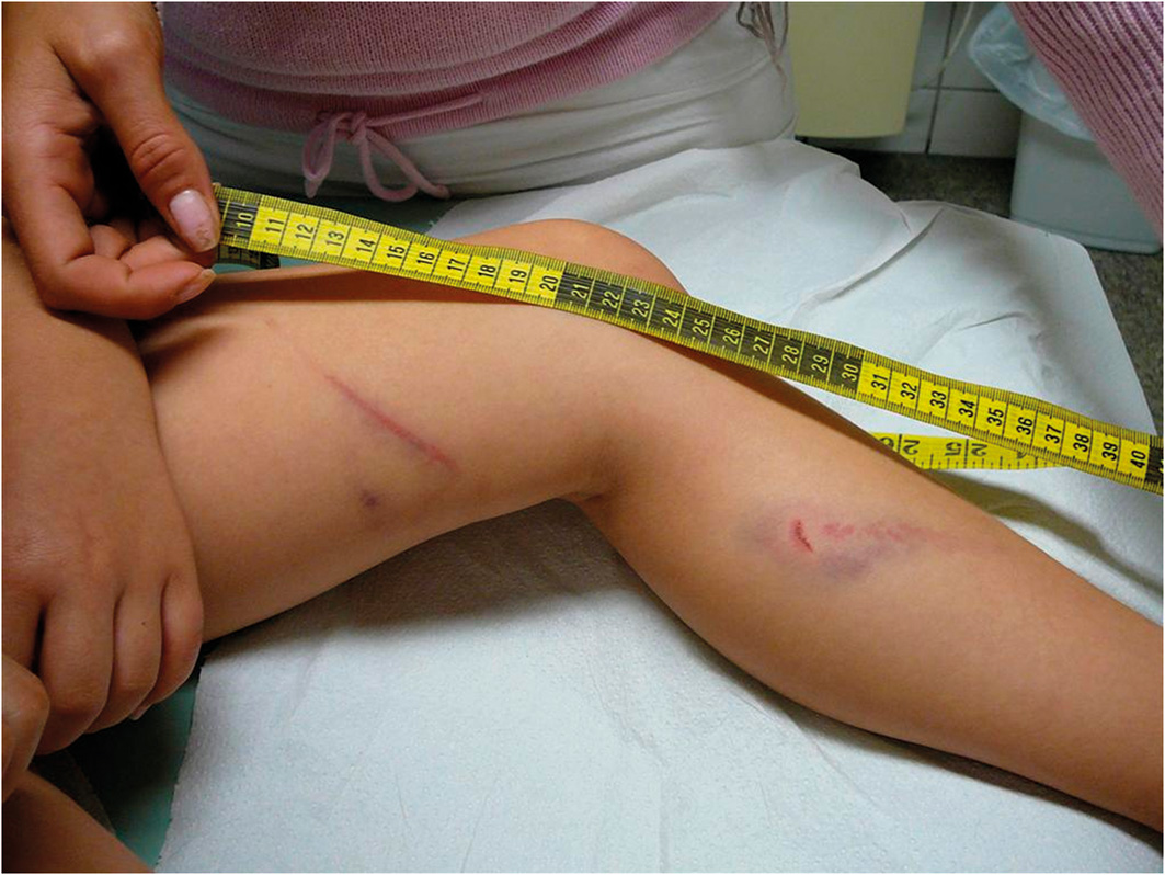 Verletzung durch ein aggressives Kindergartenkind (5 Jahre)